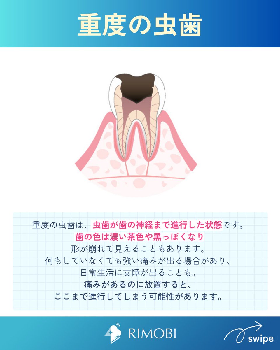 RIMOBI(リモビ)｜DENNOVATE(ディノベート)取扱 (@rimobi_dental